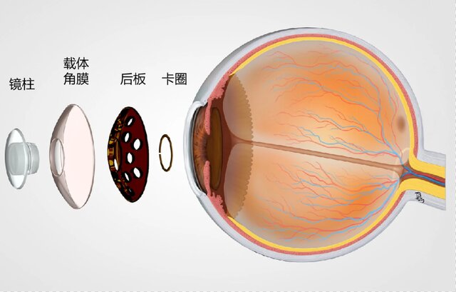 ایمپلنت مصنوعی چینی‌ها برای درمان چشم‌های آسیب دیده