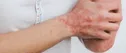 عرضه نرم‌افزاری تخصصی برای درمان مشکلات پوستی در کشور