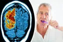 تایید ارتباط ابتلا به آلزایمر با باکتری‌های دهان
