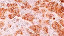 نانوفناوری RNA در حال استفاده برای درمان سرطان سینه