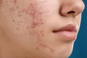 درمان آکنه با وصله ریز سوزن و اولتراساوند